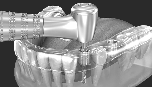 가이드 임플란트