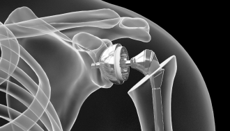 인공관절치환술